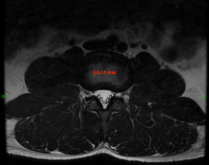 (L3-L4 Axial MRI)