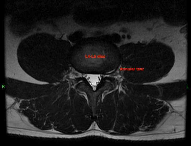 (L4-L5 Axial MRI)